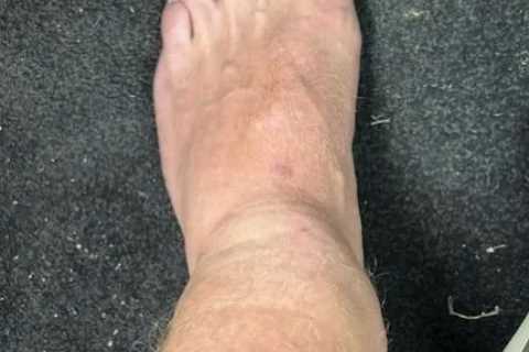 Jonny Bairstow shares gruesome pics of his broken leg as England star reveals horror injuries after freak golf accident